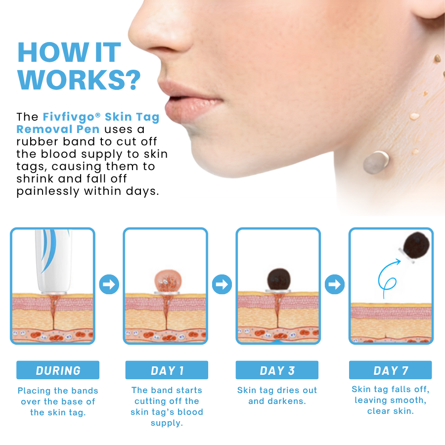 Fivfivgo® Painless At-home Skin Tag Removal Pen 22 250710 Fivfivgo PainlessAt homeSkinTagRemovalPen Img5